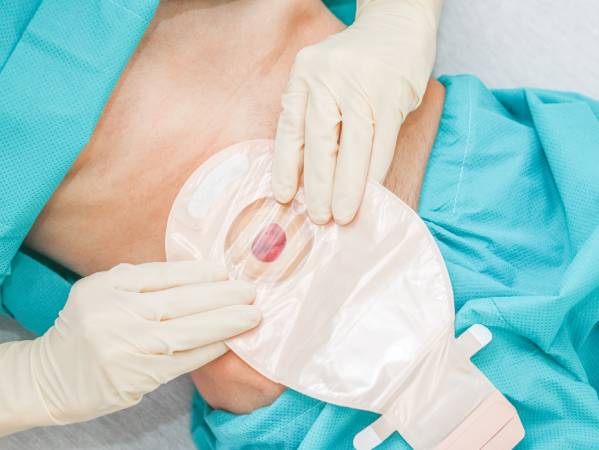 OSTOMY - Wound Care Experts